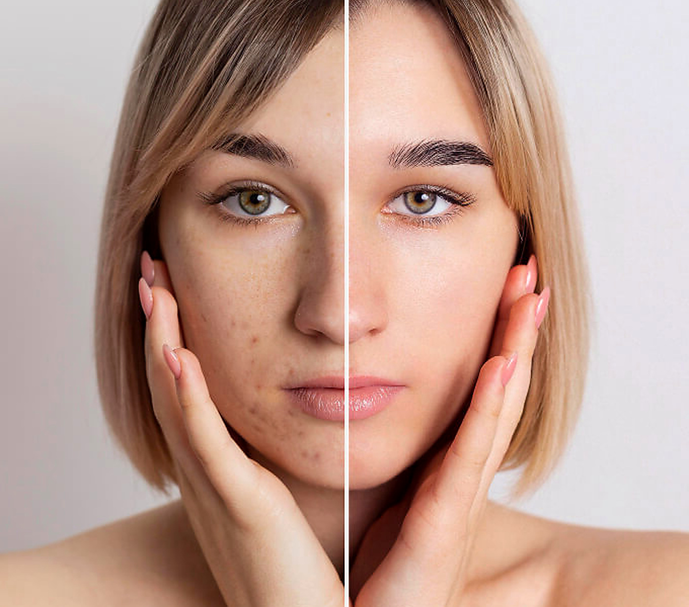 Split-face photograph documenting appearance before and after a 90-day Apexium regimen
